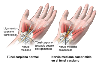 Mano y la muñeca que muestra un túnel carpiano normal y el nervio mediano comprimido en un túnel carpiano se inflama.
