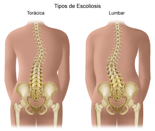 Scoliosis in Children