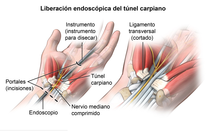 Síntomas del síndrome del túnel carpiano