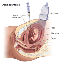 Ilustración de una amniocentesis