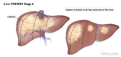 Liver PRETEXT Stage 4; drawing shows two livers. Dotted lines divide each liver into four vertical sections that are about the same size. In the first liver, cancer is shown across all four sections. In the second liver, cancer is shown in the two sections on the left and spots of cancer are shown in the two sections on the right.