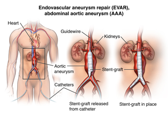 Stent graft repair of abdominal aneurysm