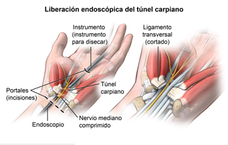 Liberación endoscópia del túnel carpiano