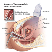 Ilustración que demuestra una muestra de vellosidad coriónica transcervical