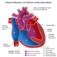 Anatomía de un corazón con atresia pulmonar con defecto septal ventricular (su sigla en inglés es VSD)