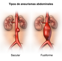 Tipos diferentes de aneurismas aórticos