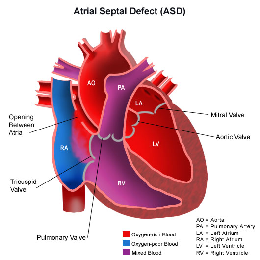 Congenital Heart Defects Chart