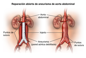 Reparación de injerto de un aneurisma abdominal