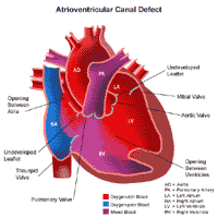 Anatomía de un corazón con una comunicación aurículoventricular