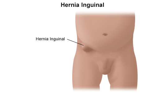 Diagnostico De La Hernia Inguinal Salud Al Dia