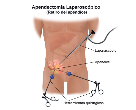 Lado del dolor de apendicitis