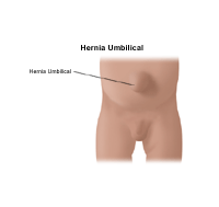 Ilustración de una hernia umbilical