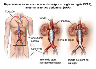 Reparación de injerto de stent 