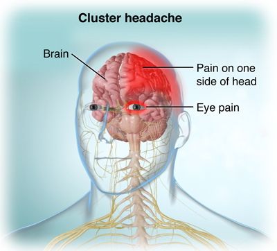 cluster headaches v0