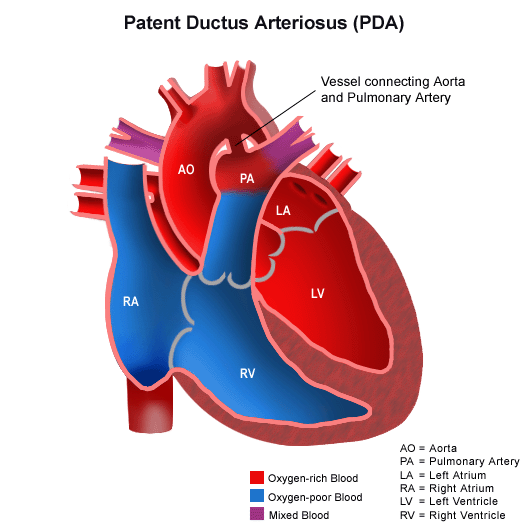 congenital heart disease