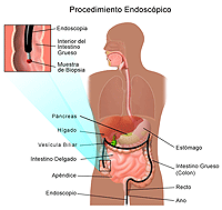 Ilustración de una colonoscopía