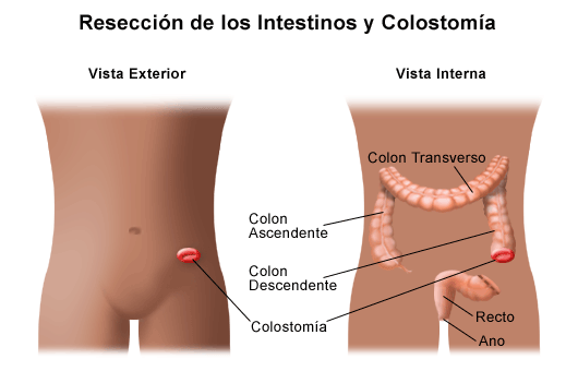 enfermedad de hirschsprung