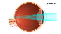 Illustration demonstrating astigmatism