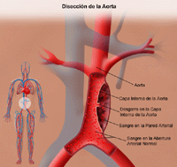 Ilustración de la disección aórtica