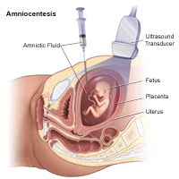 Illustration demonstrating  an  amniocentesis