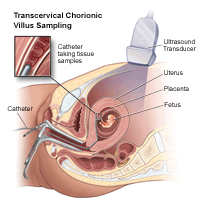 Illustration demonstrating  a  transcervical chorionic villus sampling