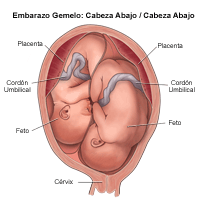 Illustrazione di un parto gemellare, testa in giù/testa in giù 