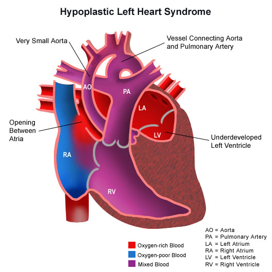 What causes hypoplastic left heart syndrome?