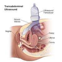 Illustration of a transabdominal ultrasound procedure