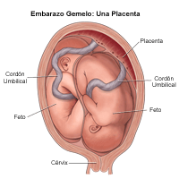 Ilustración de un nacimiento de mellizos, cabeza para abajo/cabeza para abajo; 1 placenta, 2 cordones 