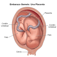 Illustration d'une naissance gémellaire, tête en bas/ tête en bas ; 1 placenta, 2 cordons