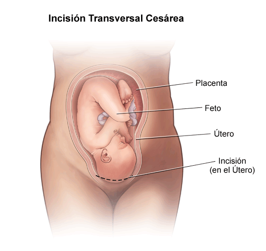 Cesarean Section - Stanford Medicine Children's Health