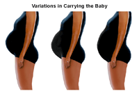 Illustration demonstrating  the  variations of carrying an unborn baby