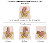 Ilustración de un parto normal y uno anormal.