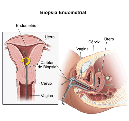 Resultado de imagen de biopsia endometrial