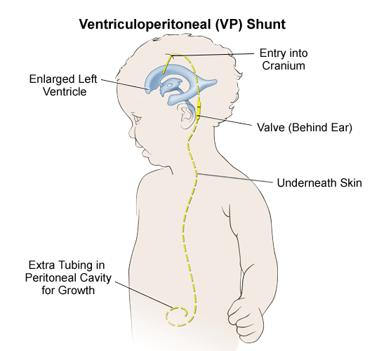 Hydrocephalus