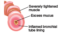 Vía respiratoria con brote de asma