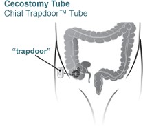 Cecostomy Tube