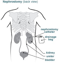 Nephrostomy back view