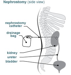 Nephrostomy side view