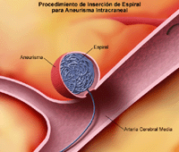 Haga clic en la imagen para ampliarla. Ilustración de un procedimiento con espiral para un aneurisma intracraneal