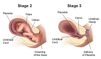 Click image to enlarge Labor Stages 2 and 3