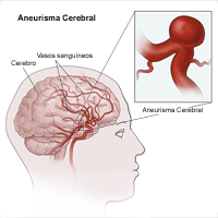 Haga clic en la imagen para ampliarla. Ilustración de un aneurisma cerebral