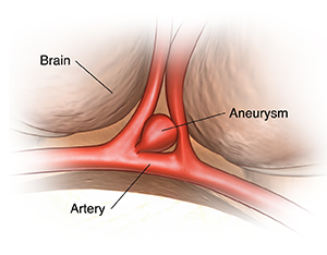 Closeup view of brain showing aneurysm on artery.