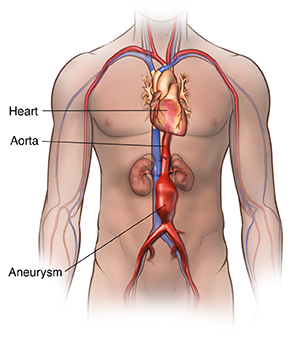 Abdominal aortic aneurysm. Front view of body showing abdominal aortic aneurysm.