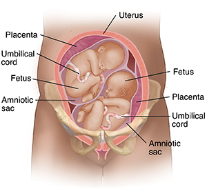 Twin pregnancy with two placentas. Front view cross section of pregnant uterus in pelvic bones showing two fetuses.