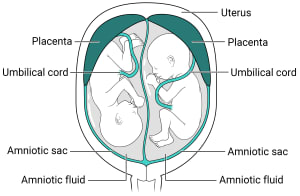 Twins with two placentas and two amniotic sacs.  Within the uterus, there are two placentas with their own amniotic sac, amniotic fluid, and fetus inside.