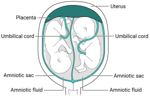 Twins with one placenta and two amniotic sacs.  Within the uterus, there is one placenta with two amniotic sacs. Each sac has its own amniotic fluid and fetus inside.