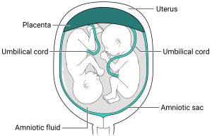 Twins with one placenta and one amniotic sac.  Within the uterus, there is one placenta with an amniotic sac, amniotic fluid, and two fetuses inside.