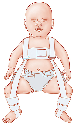 Pavlik harness Baby in Pavlik harness.