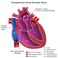Haga clic en la imagen para ampliarla. Anatomía de un corazón con transposición de las grandes arterias